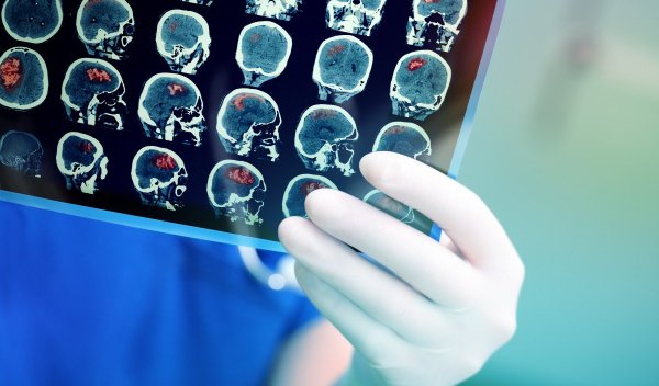 Искоренить онкологию возможно: Ученые научились замедлять клетки головного мозга