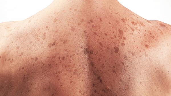 Ученые выяснили, как раковые клетки кожи уклоняются от иммунной системы