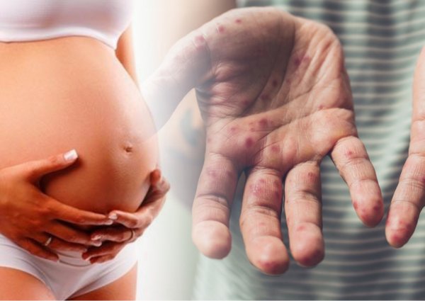 «Прививка головного мозга»: Беременная москвичка с корью поставила под угрозу жизни 40 младенцев